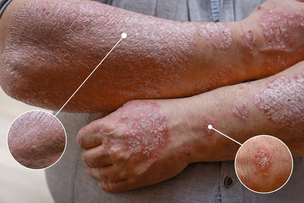 Autoimmune Conditions